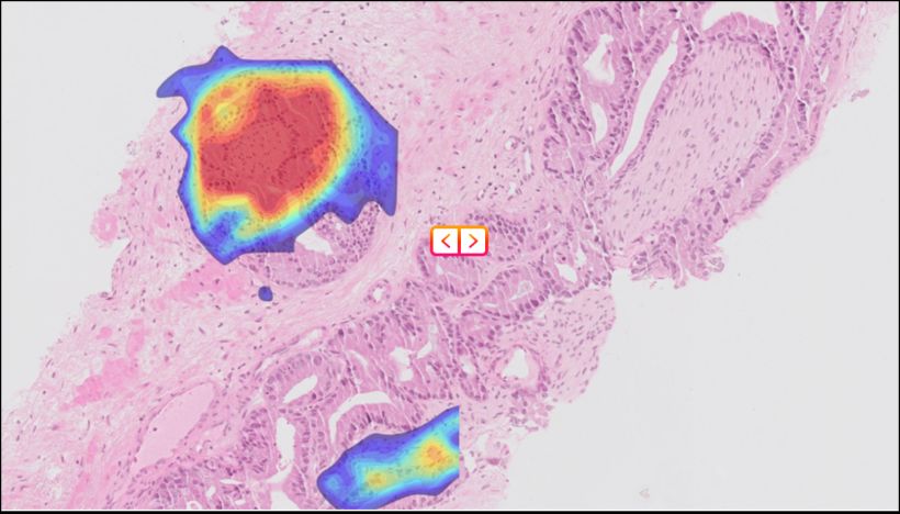 Perineural invasion heatmap